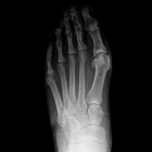 img Hallux valgus juv�nile