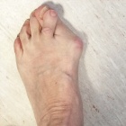 img Hallus valgus griffe du 2�me orteil 