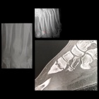 img Fracture de fatigue 