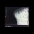 img Fracture du s�samo�de lat�ral