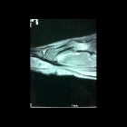 img IRM avec rupture de la plaque plantaire