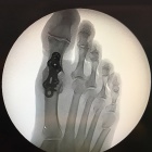 img Arthrod�se + raccourcissement des rayons lat�raux