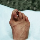 img Hallux valgus avec syndrome du 2�me rayon avec cor dorsal douloureux