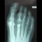 img Implant interphlex de la 2�me articulation m�tatarso phalangienne