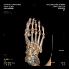 img Implant interphlex de la 2�me articulation m�tatarso phalangienne