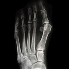 img Hallux valgus et Quintus varus