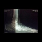 img Pied plat par rupture du spring ligt 