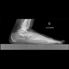 img Rx : pied plat valgus 