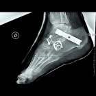 img Triple arthrod�ses