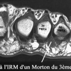 img IRM avec n�vrome de Morton du 3�me espace