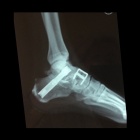 img Arthrod�se