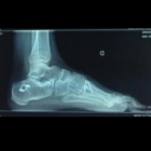 img Ost�otomie calcaneus