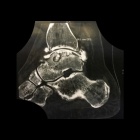img Ost�ophyte au TDM