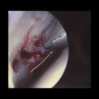 img L�sion ost�ochondrale : d�bridement perforation en arthroscopie