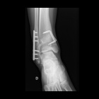 img Pylonoplastie tibiale