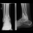 img Arthrod�se de cheville par vissage