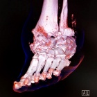 img Luxation S/T sur pied neurologique