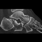 img Fracture du calcan�um