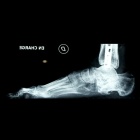 img Arthrose sur fracture du calcan�um