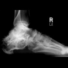 img Arthrose sous talienne