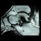 img N�crose talus