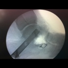img Arthrod�se par clou
