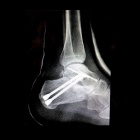 img Arthrod�se par vis