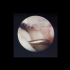 img D�tersion curetage et perforations sous arthroscopie