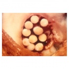 img Greffe en mosaicplasty