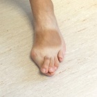 img Griffe sur hallux valgus