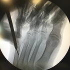 img Mini incision