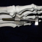 img Lib�ration endoscopique