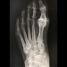 img M�tatarsus elevatus