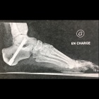 img Arthrod�se par vis
