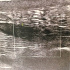 img Echographie de la talalgie