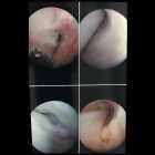 img Tenoscopie du tendon tibial post�rieur