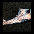 img TDM 3D pied plat valgus