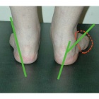 img Pied plat valgus