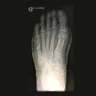 img Fracture M5 viss�e