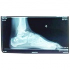 img Ost�otomie de valgisation du calcaneum