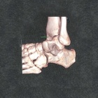 img Instabilit� du sinus du tarse