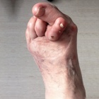 img Hallux valgus avec syndrome du 2�me rayon avec cor dorsal douloureux