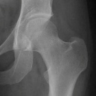 img Radiographie hanche normale de face