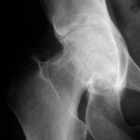 img Exemple radiographique de coxarthrose protusive
