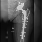 img Radiographie de reprise de proth�se totale de la hanche