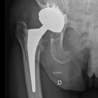 img Radiographie de reprise de proth�se totale de la hanche