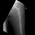 img Reprise de proth�se totale de la hanche, cause fracture 