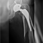 img Reprise de proth�se totale de la hanche, cause fracture 