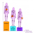 img R�partition sites fracturaires chez le patient ost�oporotique