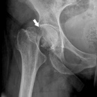 img Fracture sous-capitale col f�moral droit